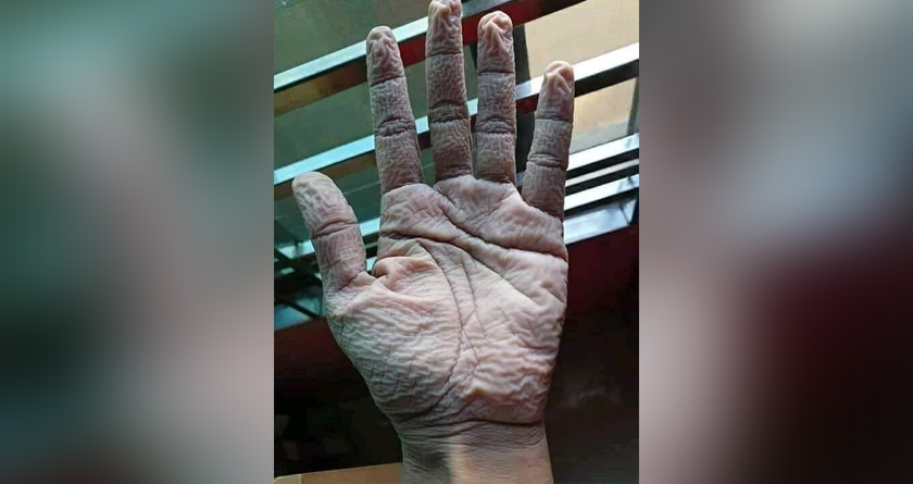A tweeted post with a picture of the wrinkled hands of a doctor wearing gloves for over 10 hours garners salute from netizens